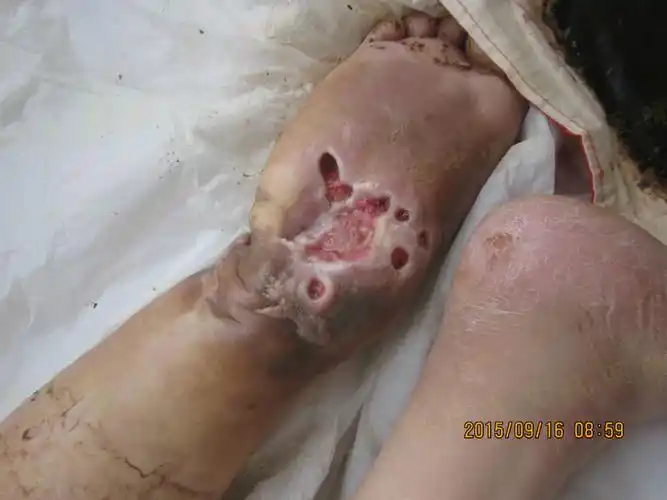 患上骨髓炎会有以下症状表现:当骨髓炎处于平静状态,不发作时,病人没