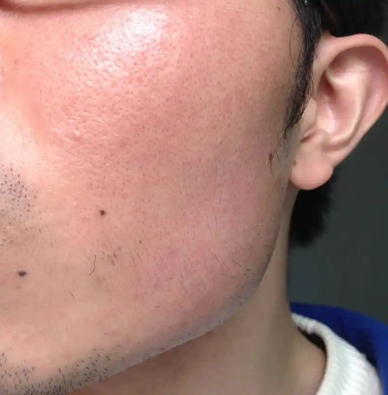 本人男,22岁,皮肤总是红红的,暗暗的,毛孔很大,有些很小很小的痘痘