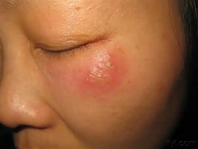 看图识病-----------------单纯疱疹 - 皮肤及性传播疾病讨论版