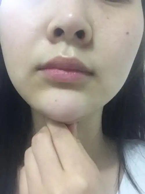 细菌感冒第二天下巴下面长了一个瘤,一夜起来就这样