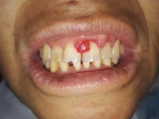 药物性牙龈增生伴牙龈瘤一例