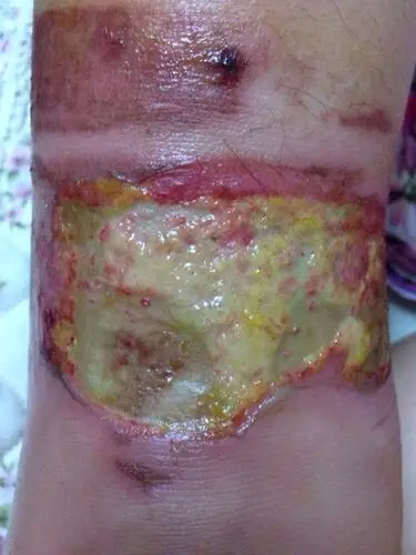 被开水烫伤后,有水泡,去医院把水泡里的水放掉了,涂抹烫伤膏,几天后