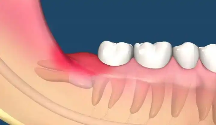 智齿,该拔就拔了吧,别舍不得