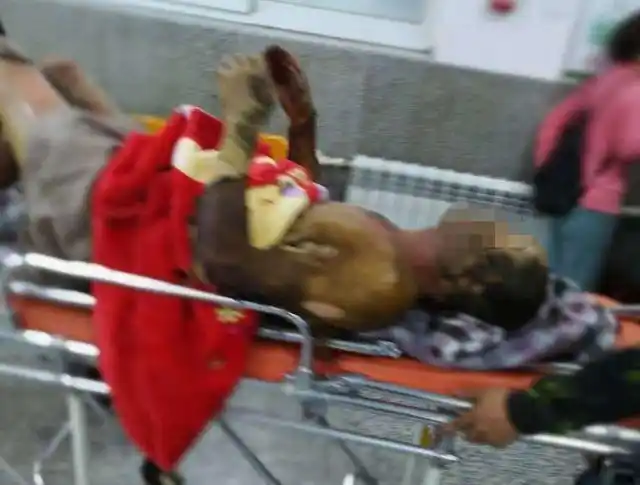 事故突发朝阳瓦房子一男子被电烧伤皮肤惨不忍睹