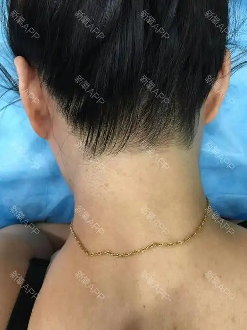 ff芳芳脱发际线术后第天美丽日记_新氧整形