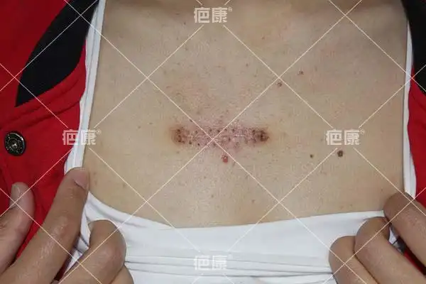 瘢痕恢复良好,不疼不痒,无任何增生迹象