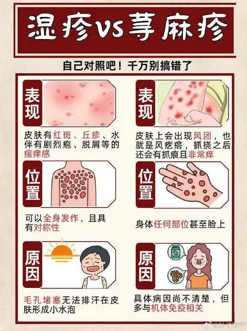怎样辨别荨麻疹还是湿疹
