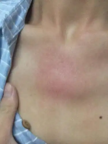 胸口这里很烫 而且很红 而且感觉喉咙老有东西 想咳嗽