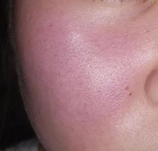 脸部泛红怎么救