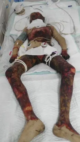 南充高坪孩子柯新春被严重烧伤请大家关注一下