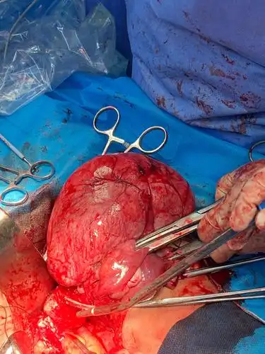 切除子宫,缝合阴道.