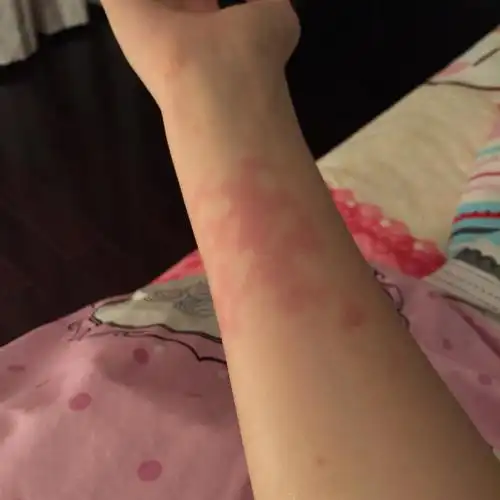 手臂不小心烫红 没有起水泡 已经涂抹芦荟胶 大概多