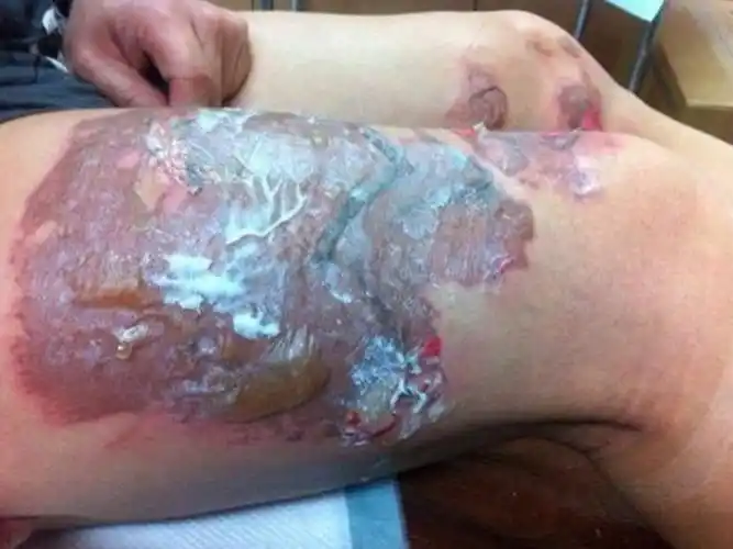 二级烫伤后恢复的图片_有来医生