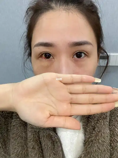 斜视手术第四天