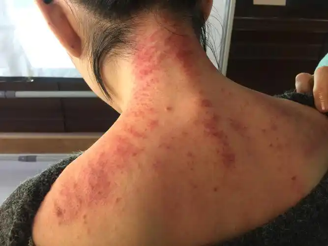 学员的颈肩问题严重,刮出的痧成黑紫色.