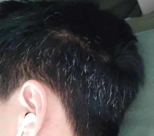 今年19,周岁18,上初中时候一根白头发没有,现在不知道咋整的长了这些