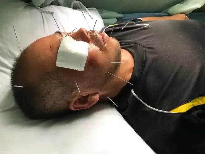 面神经炎患者针灸治疗