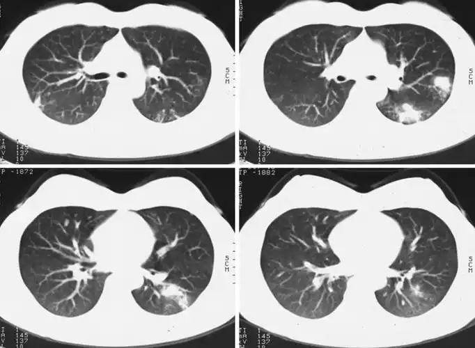 双肺支气管肺炎-ct图