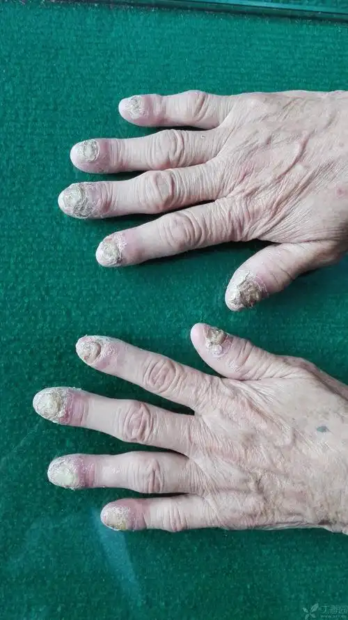 【请教】连续性肢端皮炎?脓银?