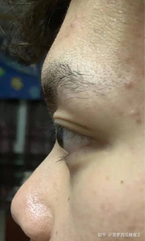 眼球突出 - 知乎