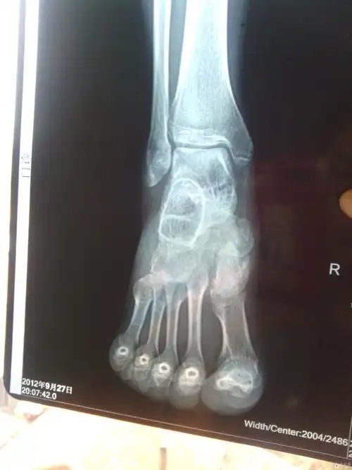 内踝骨折70天是否已经康复