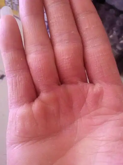 右手手心裂口怎么回事,左手好好的,是缺什么吗?疼啊,急急急