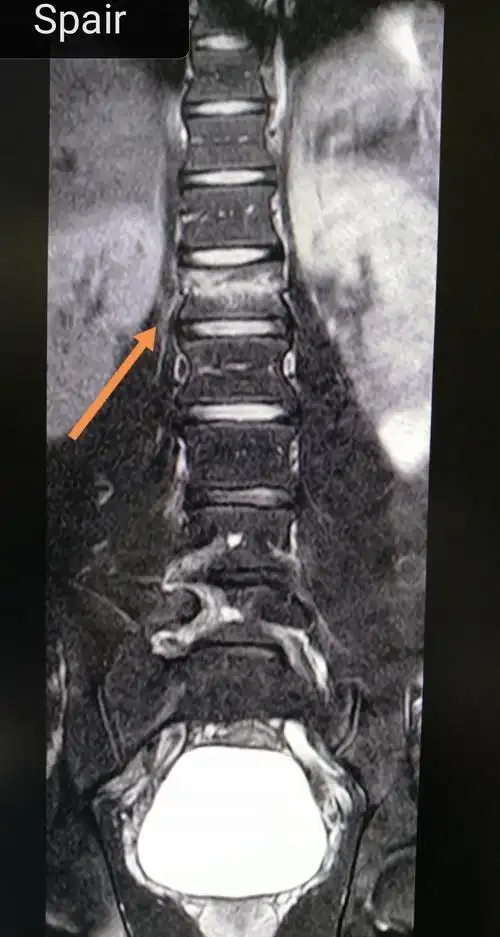 腰椎压缩性骨折(新鲜)_病史