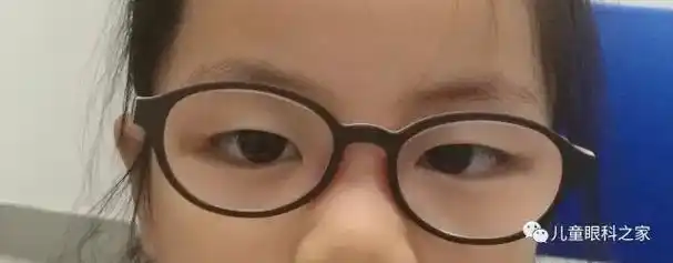 亲戚邻居朋友都说我家宝宝是斗鸡眼