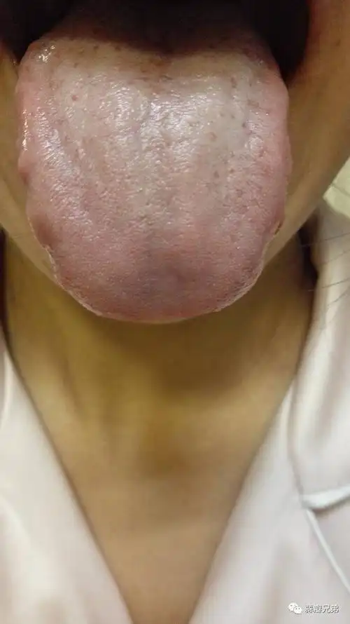 【病例解答】去年怀孕生宝宝,怀孕前就有齿痕,现在齿