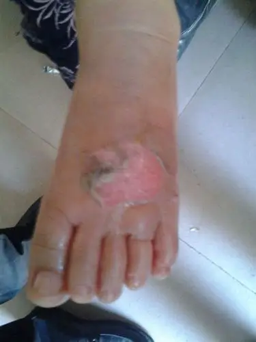 二级烫伤后恢复的图片_有来医生