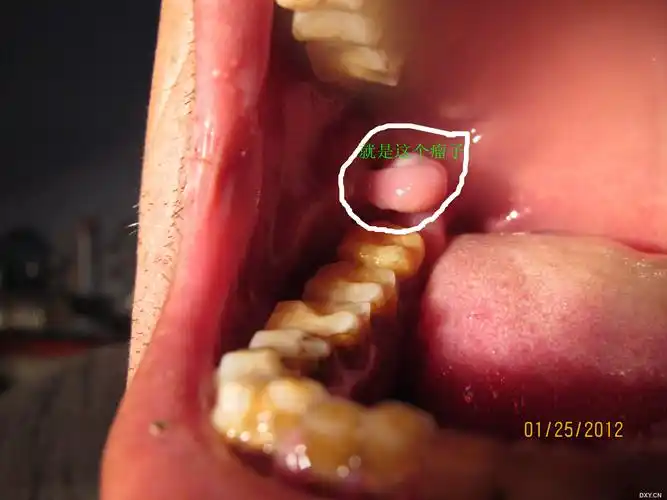 【求助】咨询口腔内壁出现一个肉瘤是什么