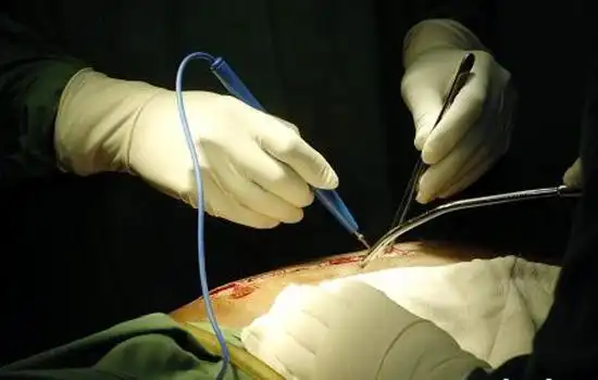 抽脂后多久能恢复 抽脂后运动需谨慎 - 7丽女性网