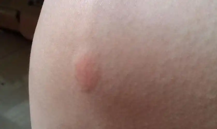 请问这些是被螨虫咬过吗