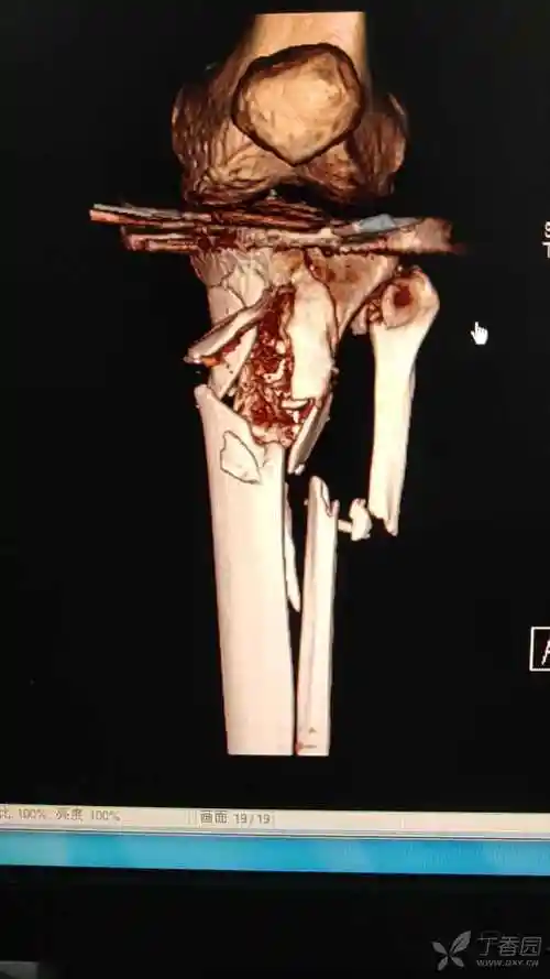 严重胫腓骨近端骨折1例 - 丁香园论坛