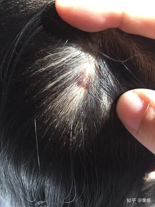 我女儿出生时发现头部有颗痣,挺大的,现在8岁了,这颗痣还在,看起来挺