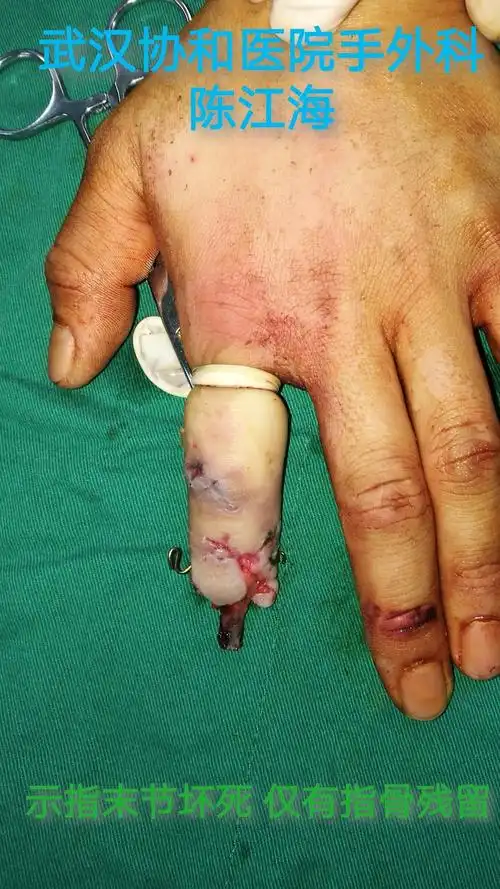 手指再造一期成形 (原创)_手术