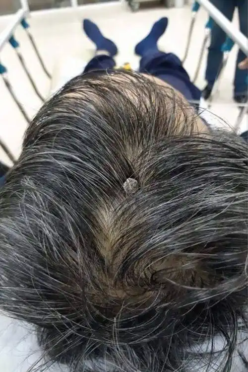 却收到最意想不到的「礼物」,医院的医生在他的头上竟发现有根钉子