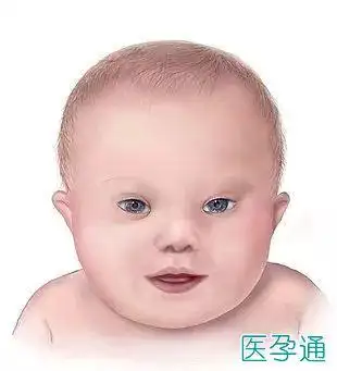 揭秘什么是小儿唐氏综合征的症状及形成的原因有哪些