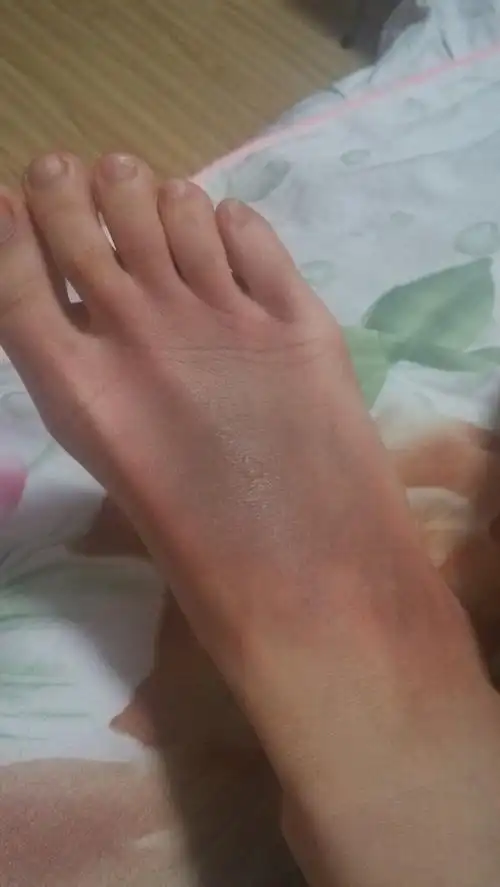 脚被开水烫伤第一天疼痛后来就好了第三天起泡了但是感觉