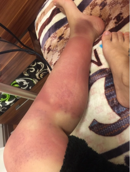 整个小腿内侧出痧