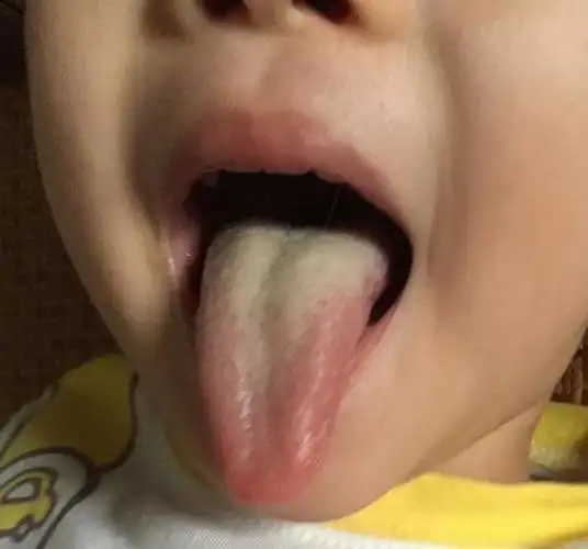 小朋友不爱吃饭,看到有这样的舌苔很有可能积食了.