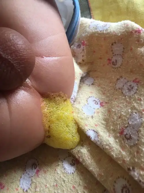 宝宝拉泡沫,这样严重么,孩怎么办?