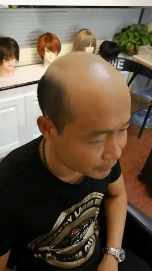 秃顶很多年,终于有了自己的新发型,心情也变好了