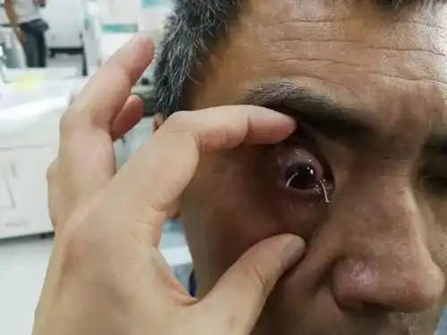 巧手还他清晰视界 不止带来"三天光明"——我院眼