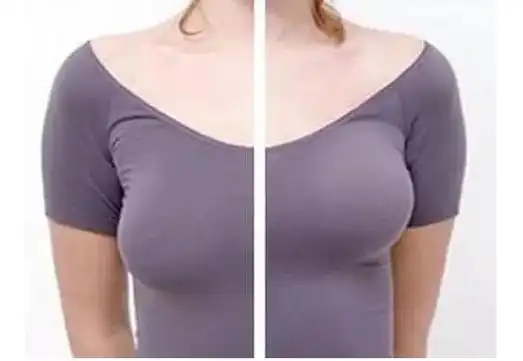 乳房下垂矫正术手术介绍乳房下垂双环法矫正术通过设计双环形切口,将