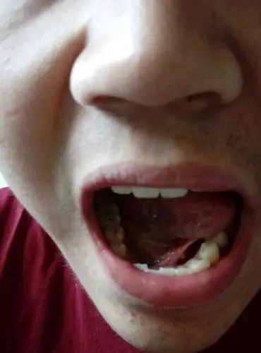 舌头下颚连接处 起了一个小包 有些疼2天了 是跟高烧上火 有关么 如何