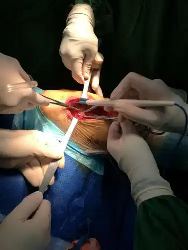 显露结扎旋股外侧血管