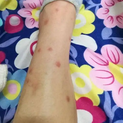 蜱虫叮咬的症状图片蜱虫叮咬后怎么处理
