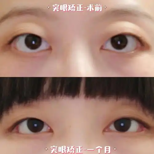 眼眶减压(五)~术后一个月