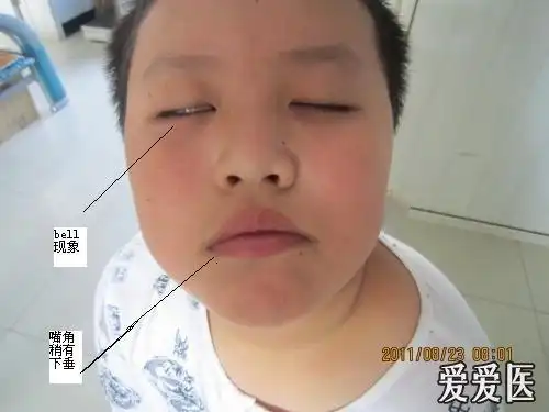 小儿面瘫一例